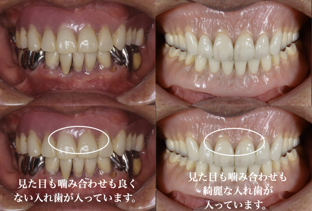 山口県下関市のおおむら歯科医院で、磁性アタッチメントを用いた精密な入れ歯の治療を行いました。